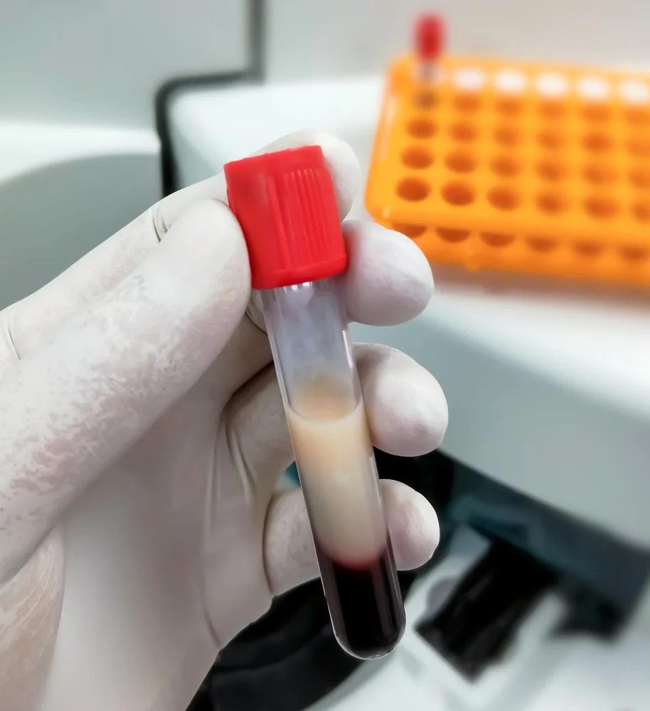 Home Blood Test In Jodhpur